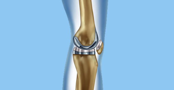 Attune Knee - the Latest Implant for a Better Knee Function and Long Life.