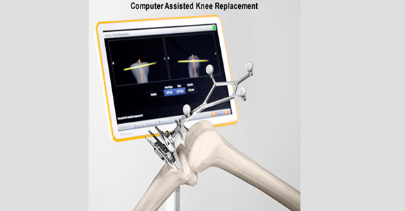 To Date With, is there a Technology Which can Challenge the Computer Assisted Knee Replacement?