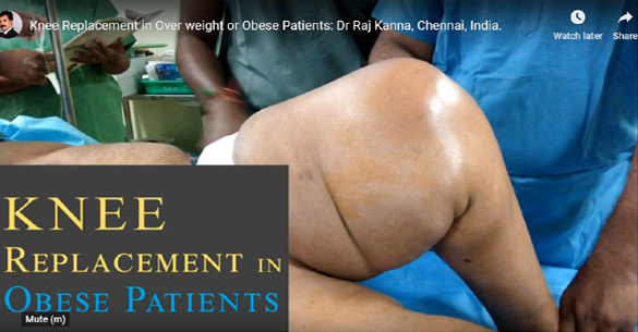 Knee Replacement in Over weight or Obese Patients – Role of Navigation
