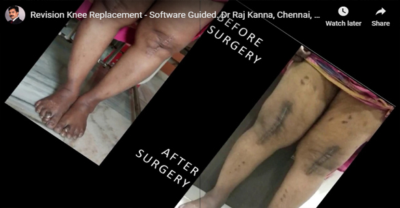 Revision Knee Replacement - Software Guided